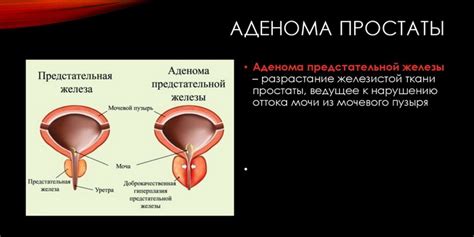 Что такое обследование предстательной железы?