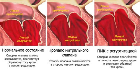 Что такое пролапс митрального клапана и его возможные причины