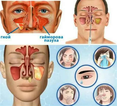 Что такое простуда и как ее лечить эффективно?