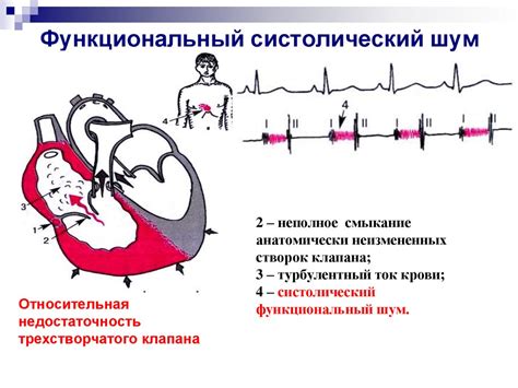 Что такое систолический шум в точке Боткина?