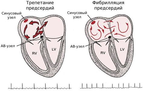 Что такое трепетание предсердий?