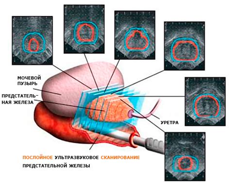 Что такое хирургическая капсула предстательной железы?