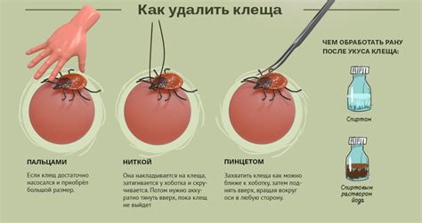 Шаги для оказания первой помощи после укуса пчелы