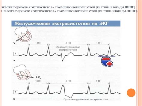 Экстрасистолия: проявления и механизмы