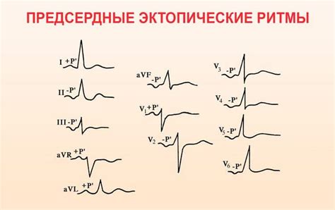 Эктопический предсердный ритм у ребенка