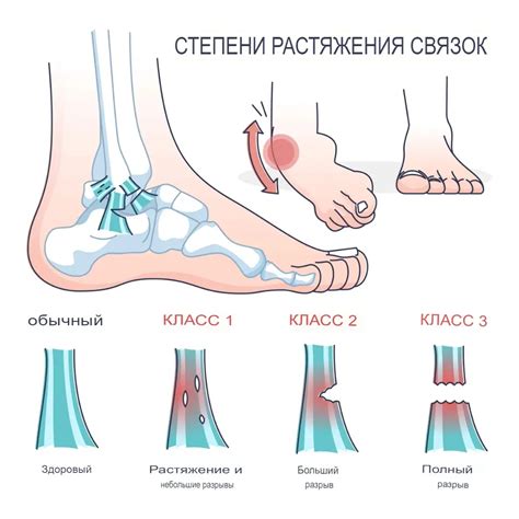 Этап 4: Возможные методы лечения растяжения связок на ступне