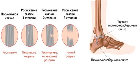 Этап 6: Профилактика растяжения связок на ступне