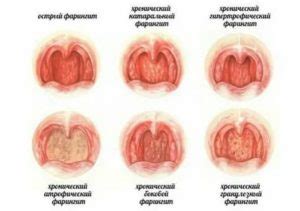 Язвочки на задней стенке горла