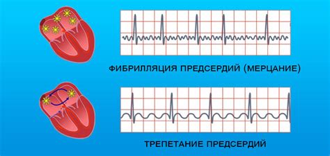  Как диагностировать трепетание предсердий? 