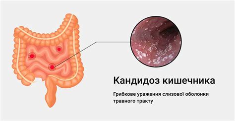  Основные симптомы Candida spp у женщин 