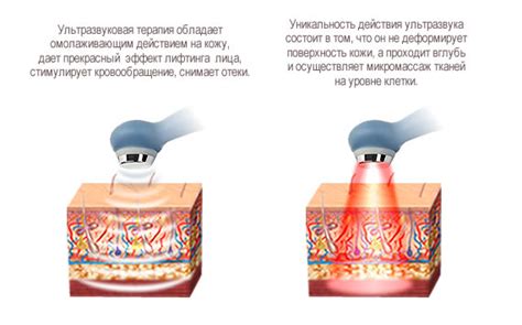  Ультразвуковая терапия: эффективность и безопасность 