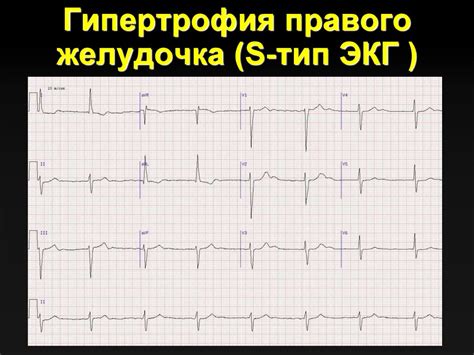 S тип экг у взрослых - причины и особенности этого состояния